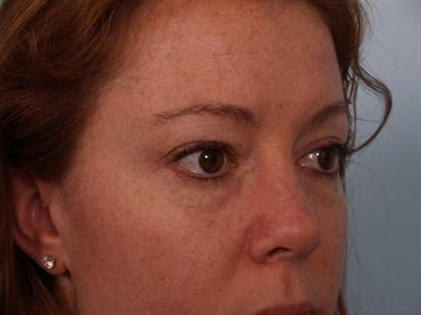 Blepharoplasty before photo