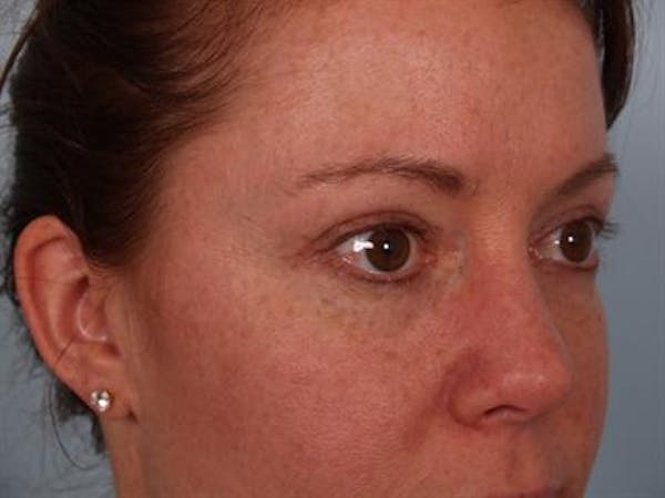 Blepharoplasty result at Dr. Robert Cohen Plastic Surgery