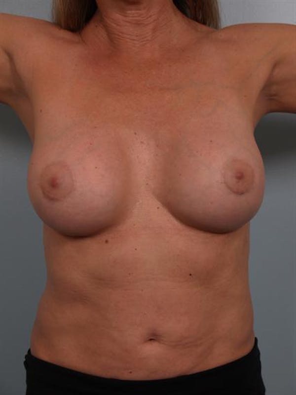 Implant Revision result at Dr. Robert Cohen Plastic Surgery