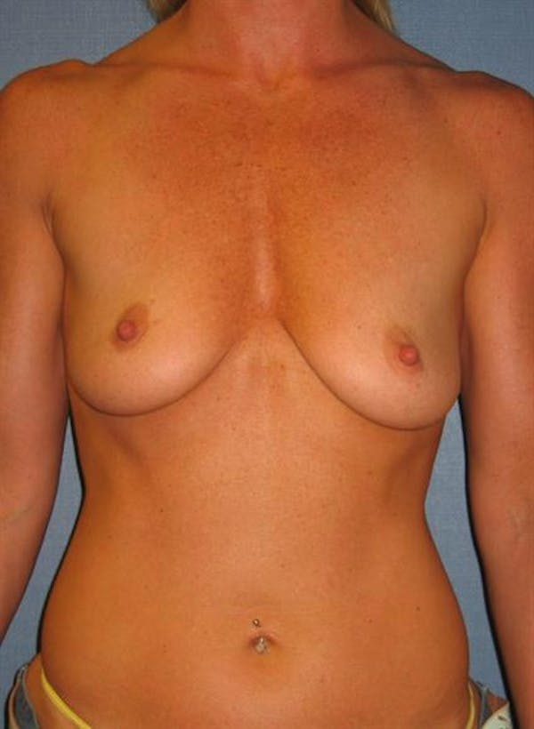Breast Augmentation before photo