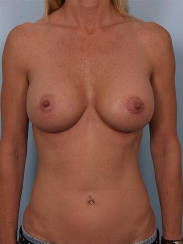 Breast Augmentation result at Dr. Robert Cohen Plastic Surgery