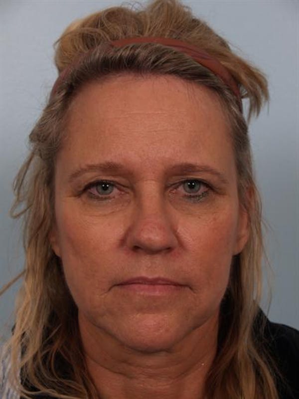 Brow Lift before photo