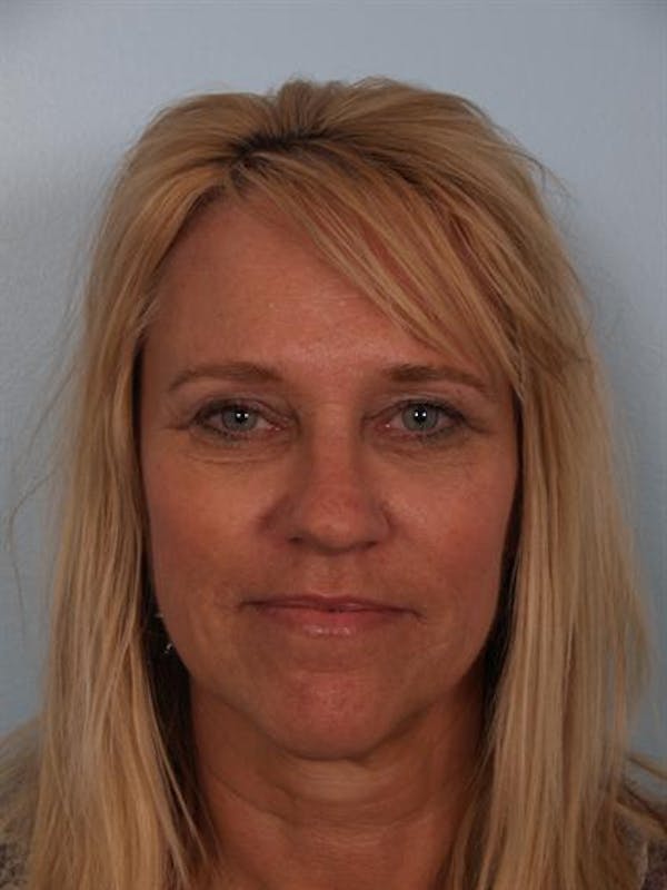 Brow Lift result at Dr. Robert Cohen Plastic Surgery
