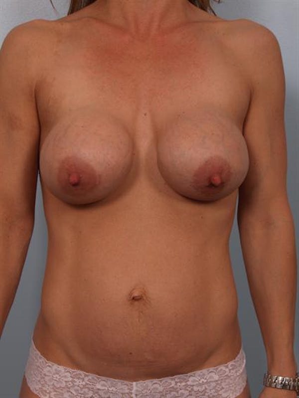 Tummy Tuck before photo