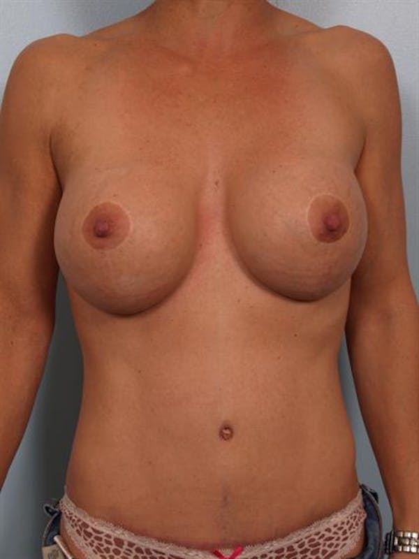 Tummy Tuck result at Dr. Robert Cohen Plastic Surgery