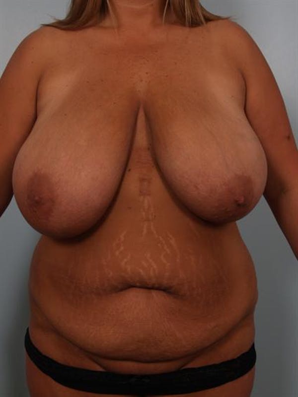 Breast Reduction before photo