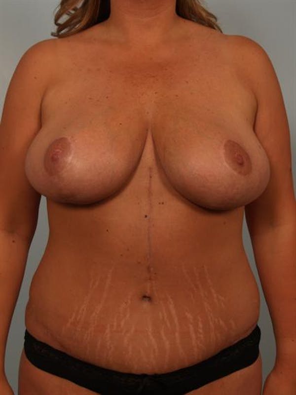 Breast Reduction result at Dr. Robert Cohen Plastic Surgery