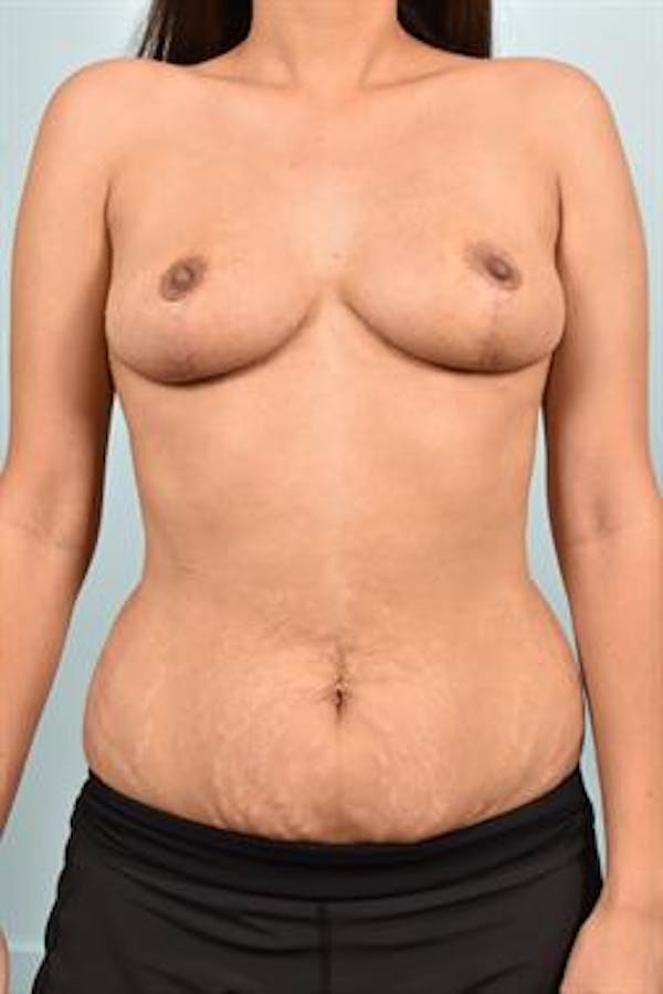 Breast Reduction before photo