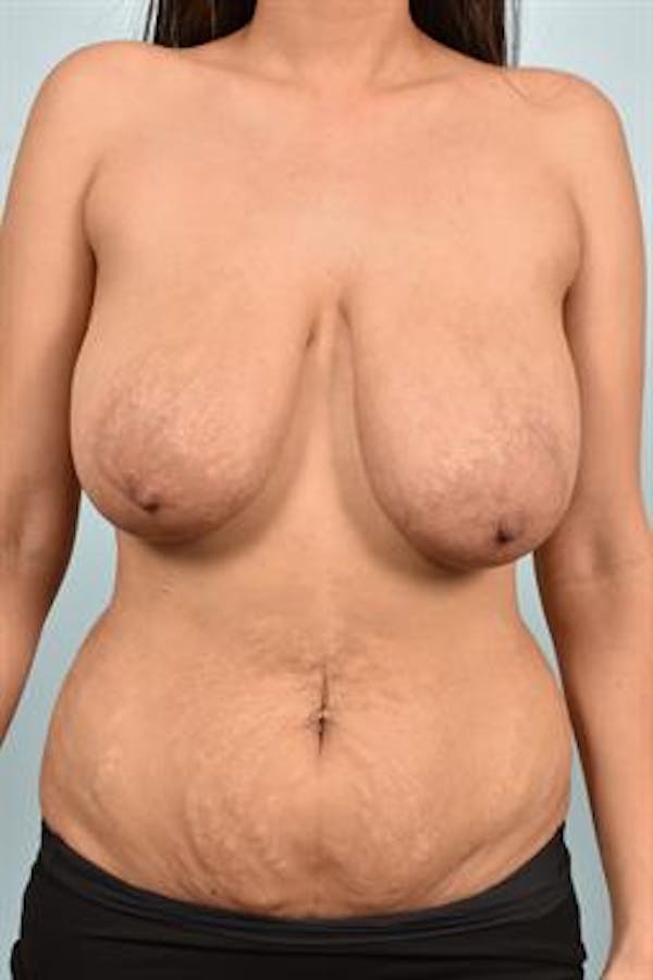 Breast Reduction result at Dr. Robert Cohen Plastic Surgery