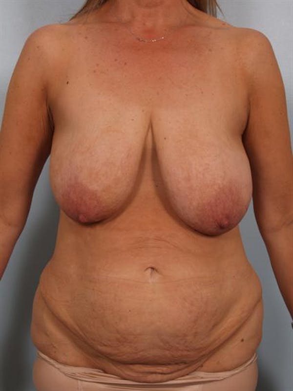 Mommy Makeover before photo