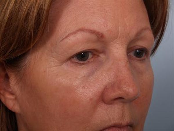 Blepharoplasty before photo