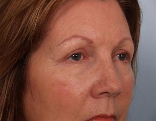 Blepharoplasty result at Dr. Robert Cohen Plastic Surgery