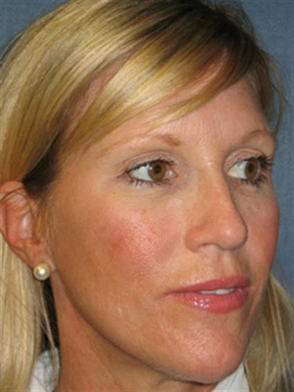 Brow Lift result at Dr. Robert Cohen Plastic Surgery