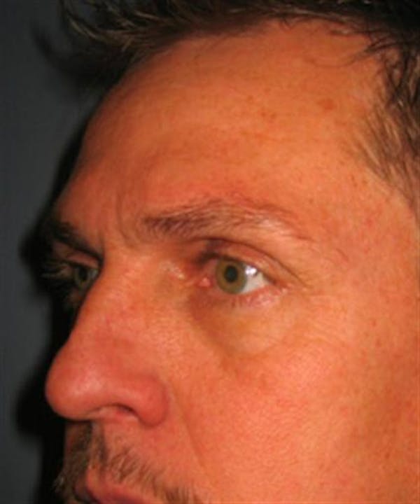 Blepharoplasty before photo