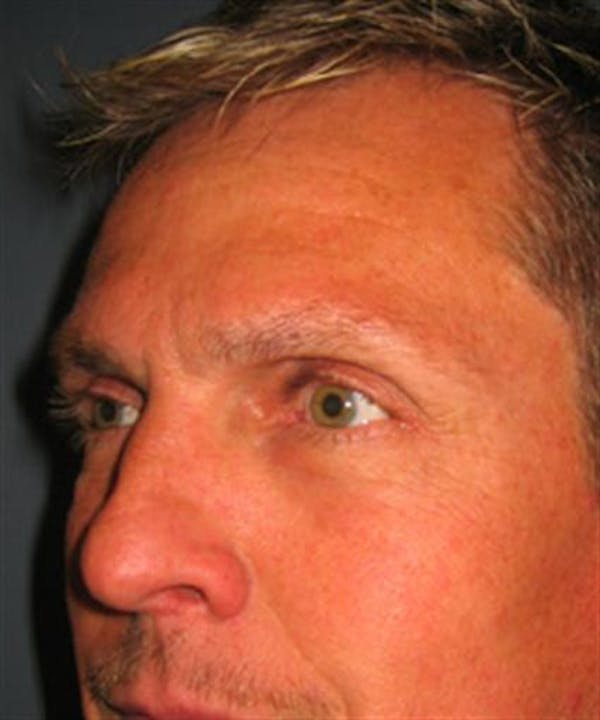 Blepharoplasty result at Dr. Robert Cohen Plastic Surgery