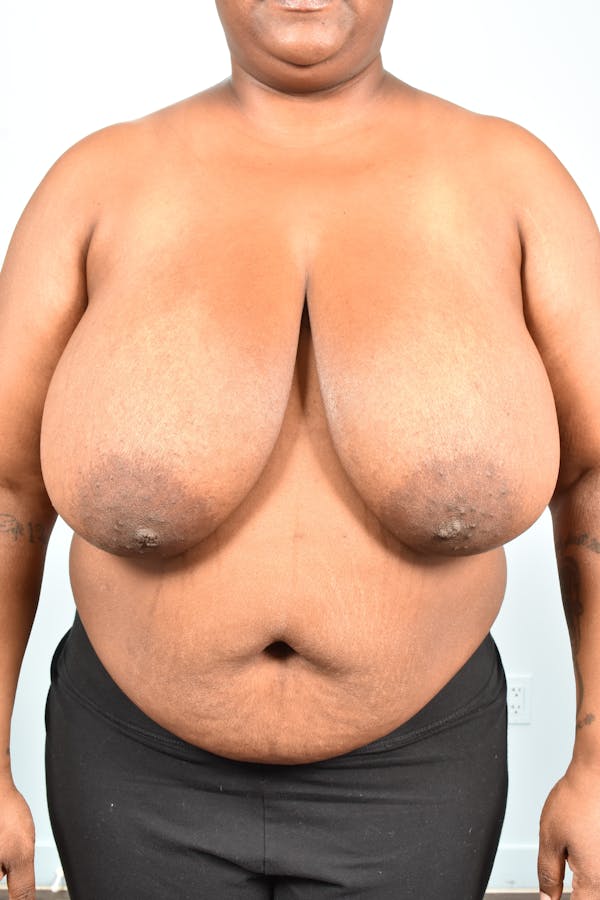 Breast Reduction before photo