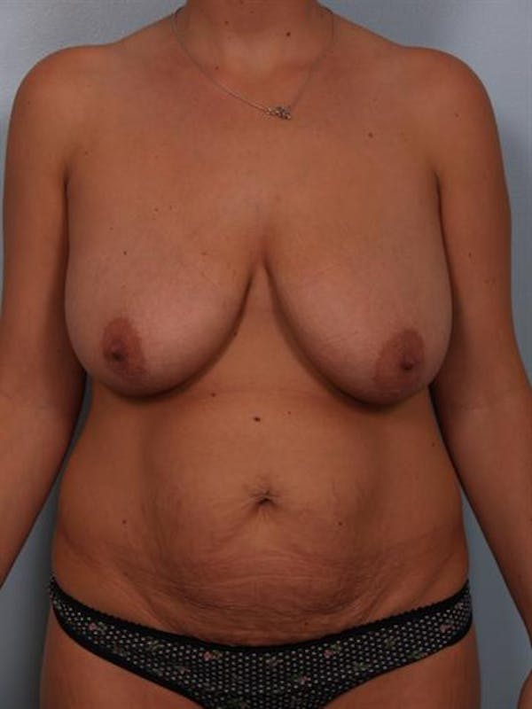Tummy Tuck before photo
