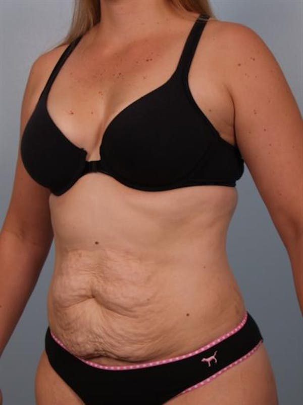 Tummy Tuck before photo