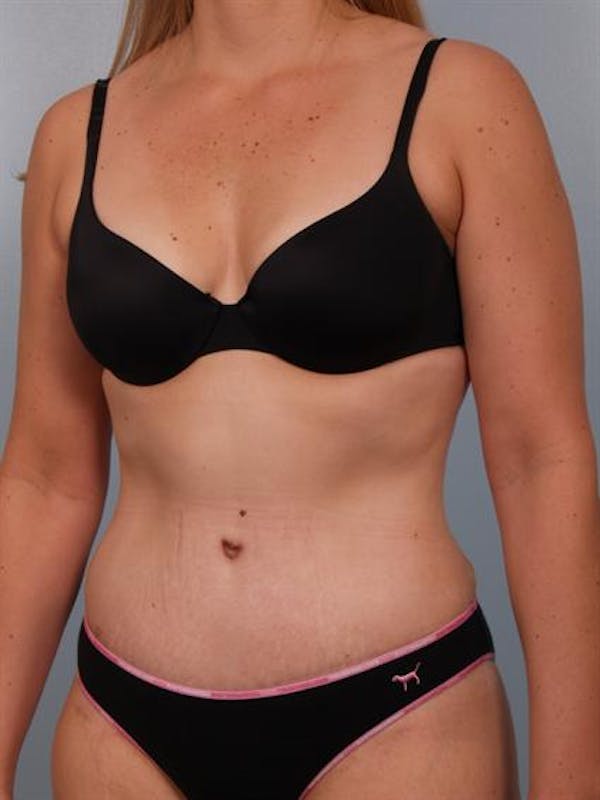 Tummy Tuck result at Dr. Robert Cohen Plastic Surgery