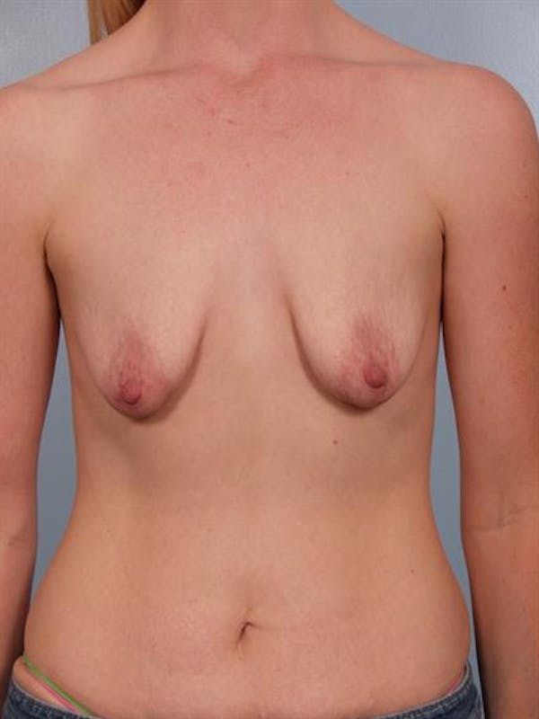 Breast Lift before photo