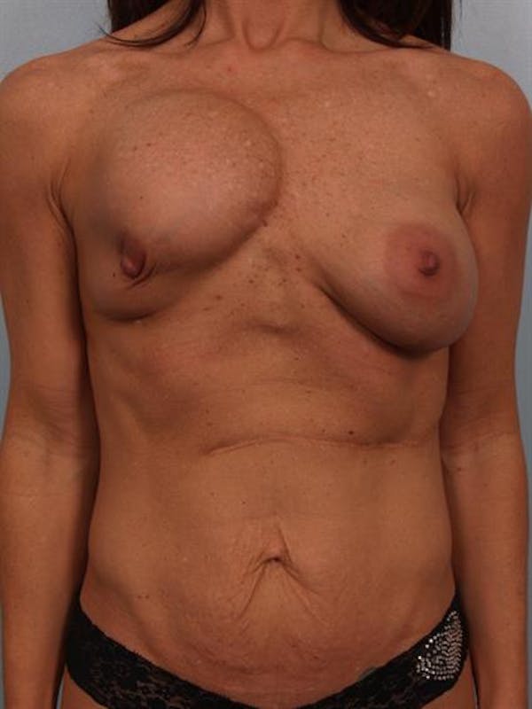 Breast Lift before photo