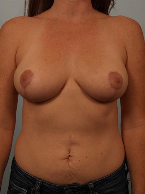 Breast Reduction result at Dr. Robert Cohen Plastic Surgery