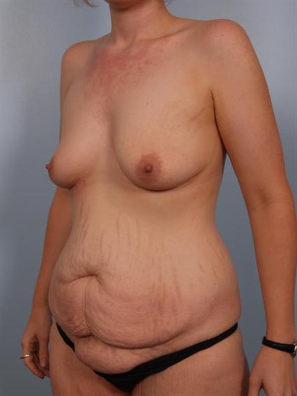 Tummy Tuck before photo