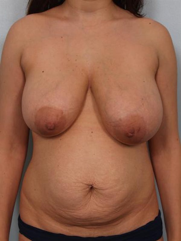 Tummy Tuck before photo