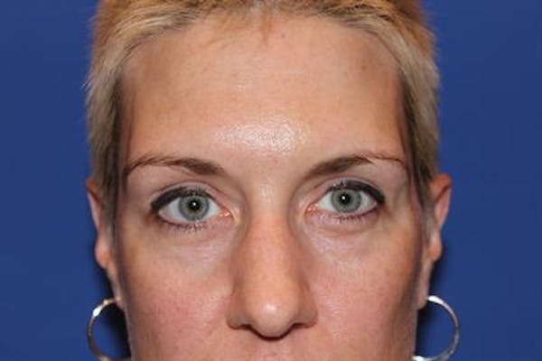 Blepharoplasty before photo