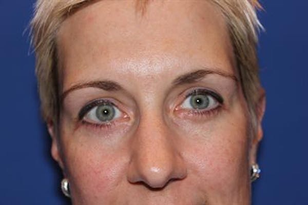 Blepharoplasty result at Dr. Robert Cohen Plastic Surgery