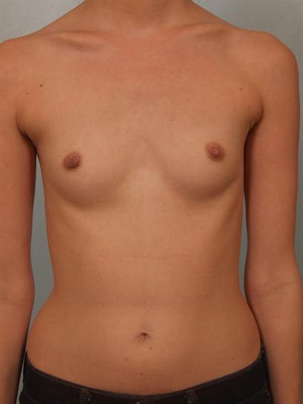 Breast Augmentation before photo
