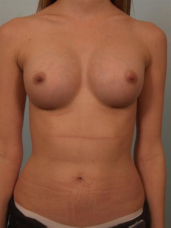 Breast Augmentation result at Dr. Robert Cohen Plastic Surgery