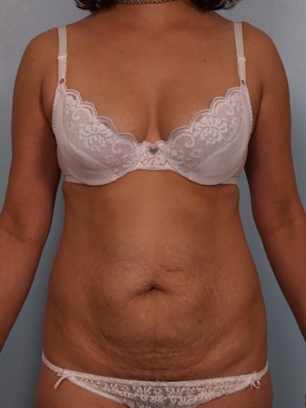 Tummy Tuck before photo