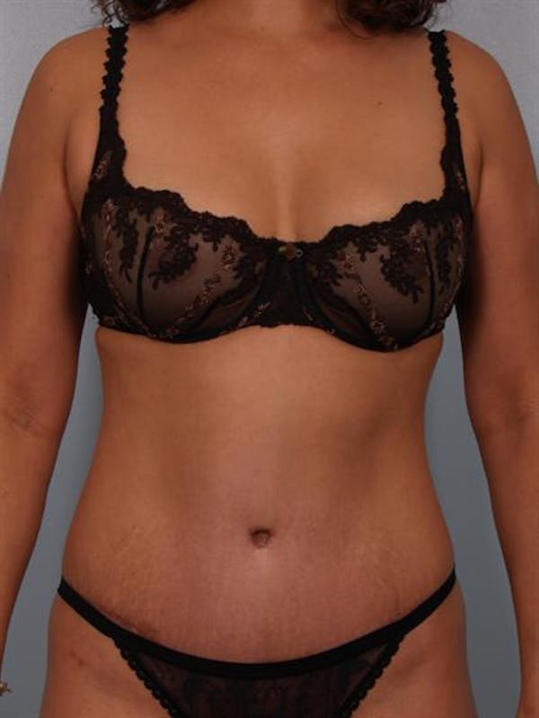 Tummy Tuck result at Dr. Robert Cohen Plastic Surgery