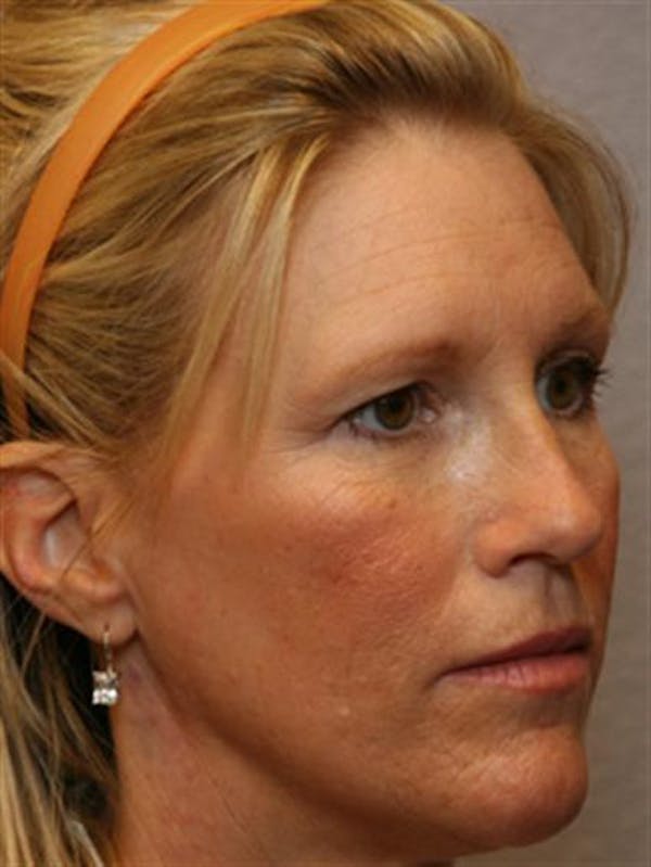 Blepharoplasty before photo
