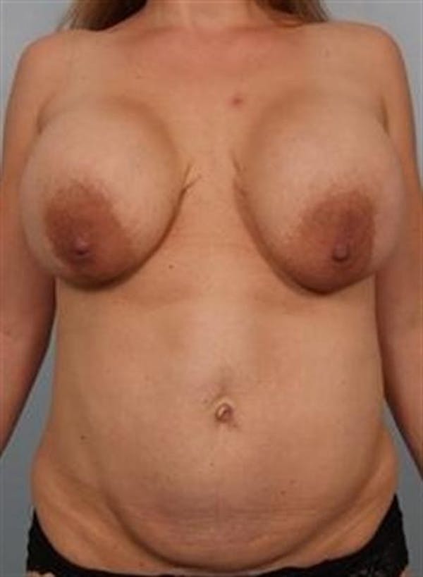Tummy Tuck before photo
