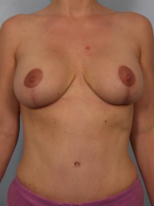 Tummy Tuck result at Dr. Robert Cohen Plastic Surgery