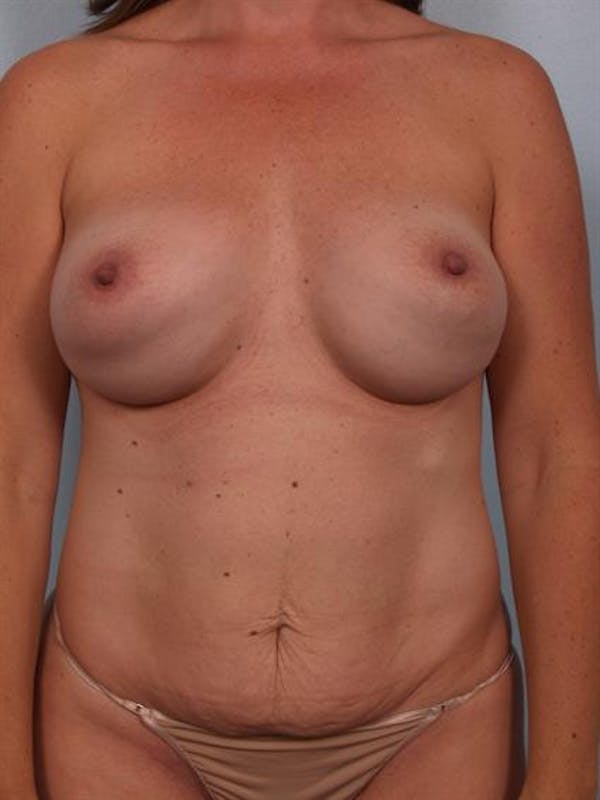 Implant Revision before photo