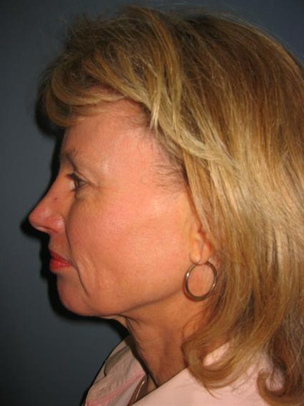 Facelift before photo