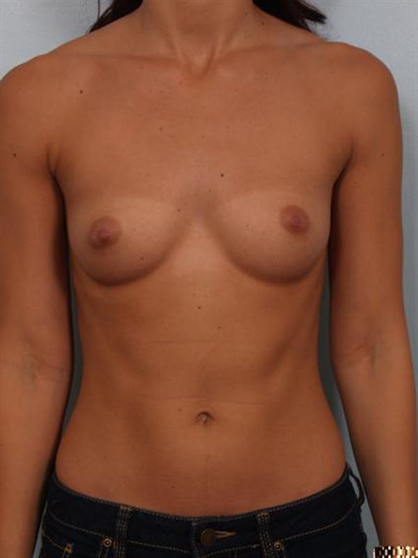 Breast Augmentation before photo