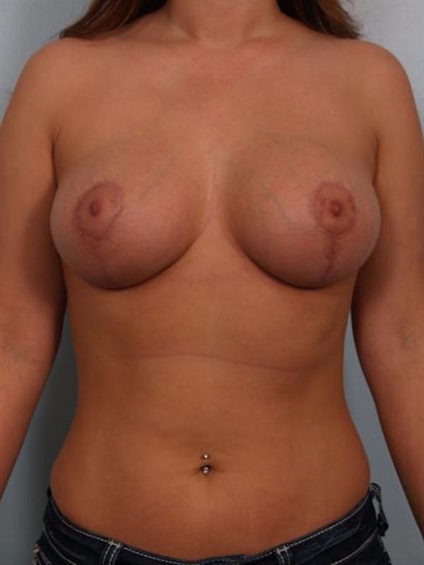 Breast Lift result at Dr. Robert Cohen Plastic Surgery