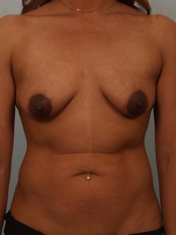 Breast Lift before photo