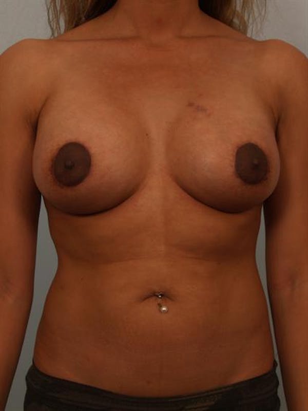 Breast Lift result at Dr. Robert Cohen Plastic Surgery