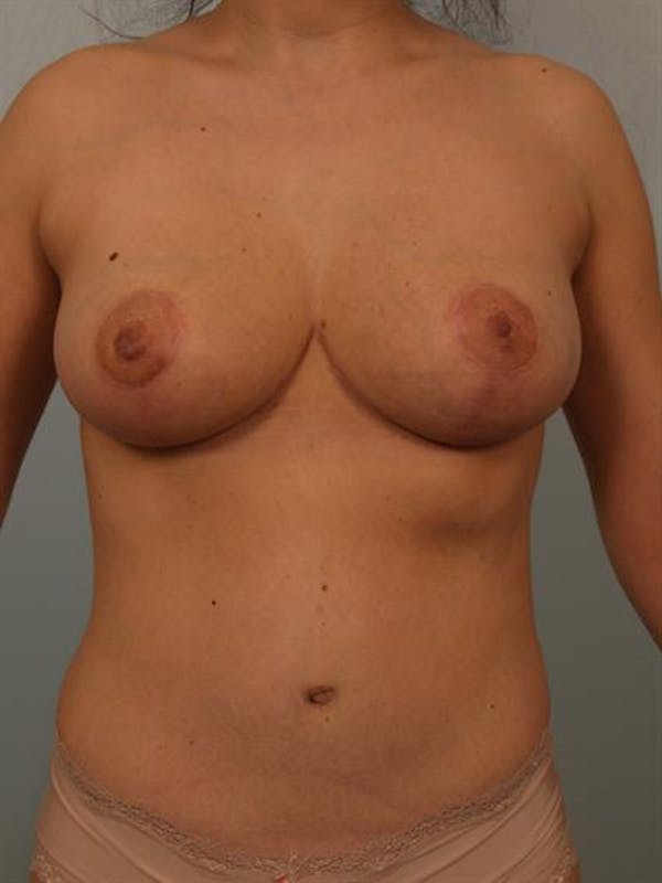 Mommy Makeover result at Dr. Robert Cohen Plastic Surgery