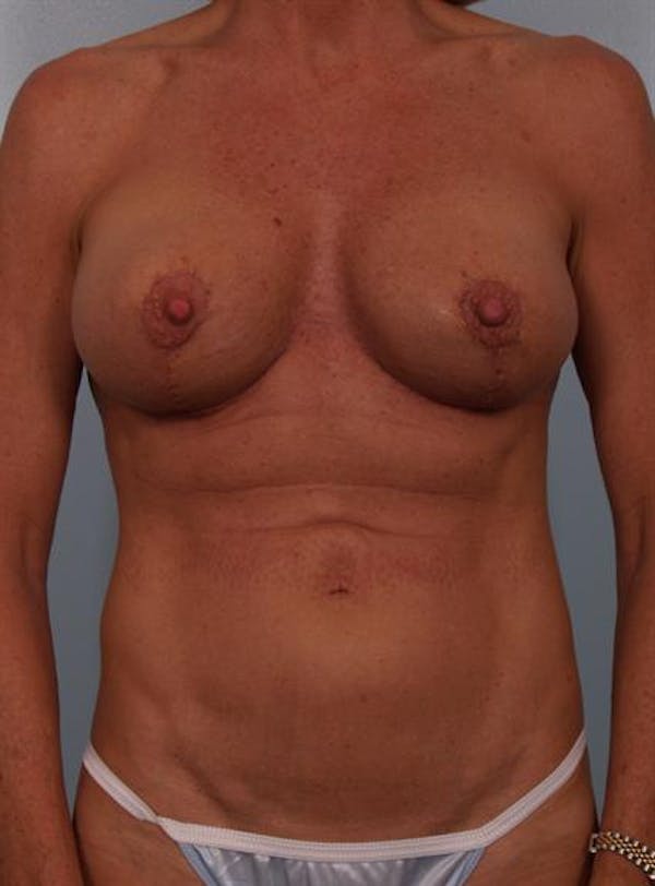 Implant Revision result at Dr. Robert Cohen Plastic Surgery
