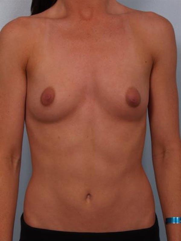 Breast Augmentation before photo