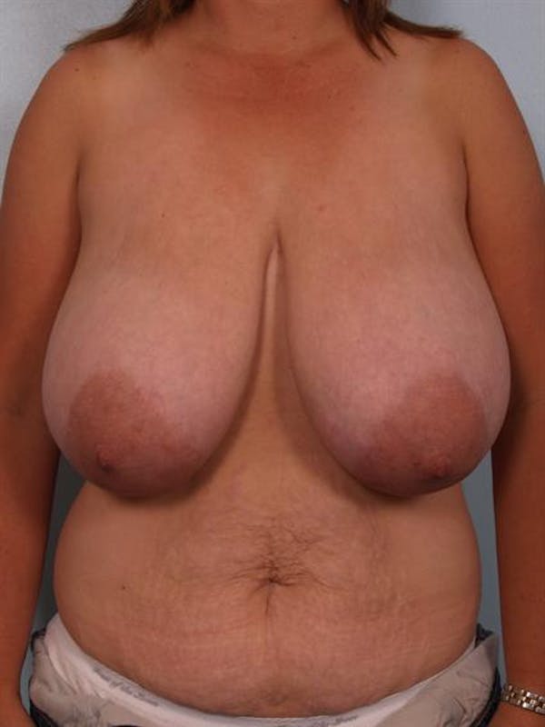 Breast Reduction before photo