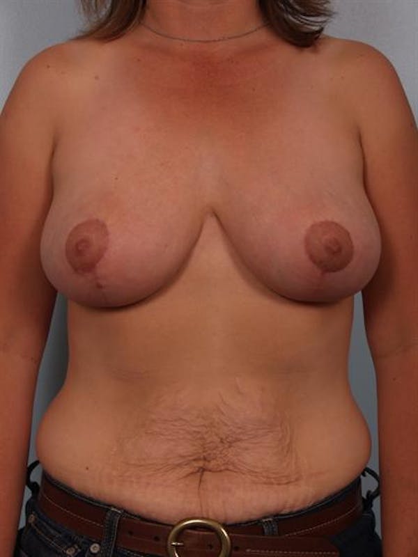 Breast Reduction result at Dr. Robert Cohen Plastic Surgery