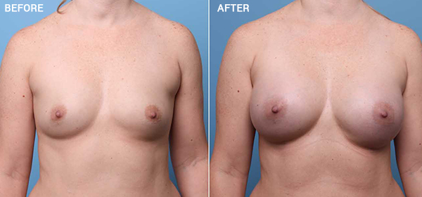 A result from Nebraska Medicine Village Pointe Aesthetic Surgery | Dreams MedSpa