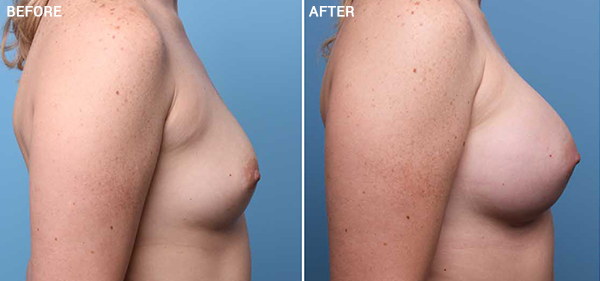 A result from Nebraska Medicine Village Pointe Aesthetic Surgery | Dreams MedSpa